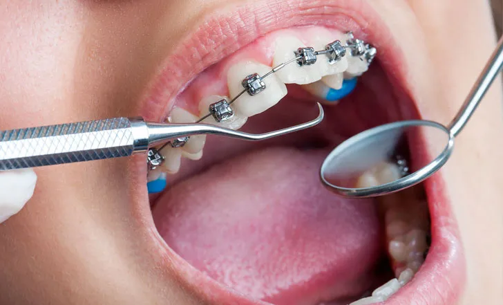 Orthodontic Surgery